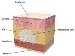 Injection-hyaluronic-acid-calves